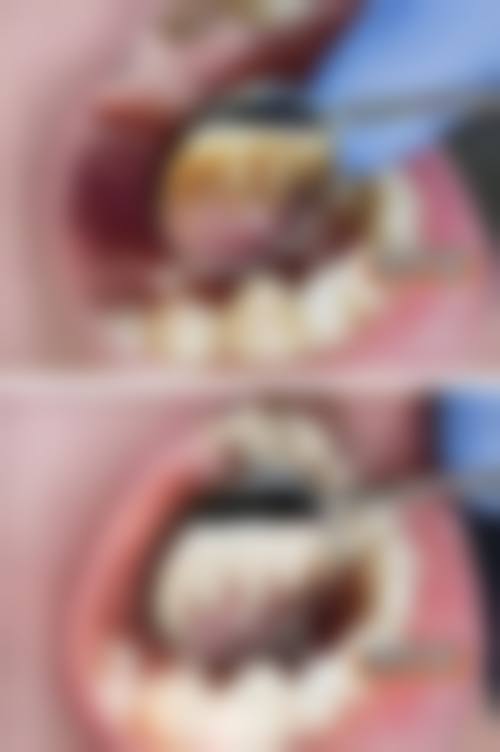 为什么珠海本地人更愿意选择珠海拜博口腔医院的程峰医生？