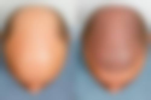 五、厦门大麦微针植发价格表