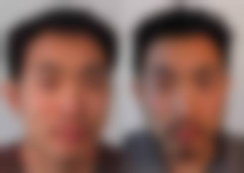 二、厦门大麦微针植发怎么样?