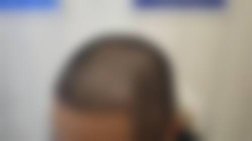 三、厦门大麦微针植发诊疗项目有哪些?
